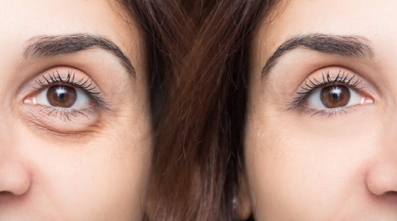 Consejos para reducir ojeras y bolsas de los ojos