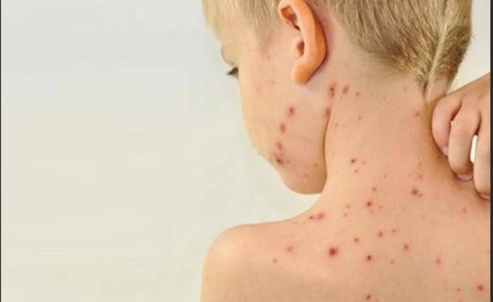 Prevención y Vacunación: Claves para Controlar el&nbsp;Sarampión»